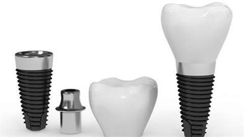 种植牙后如何护理？专家教你三招延长使用寿命