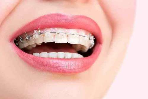 矫正两个牙齿多少钱？一文全面点评